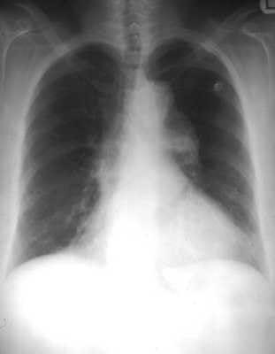 Pleural space can be invaded by fluid, air, and particles from different parts of the body which fairly complicates the diagnosis. Viral infection (coxsackievirus, RSV, CMV, adenovirus, EBV, parainfluenza, influenza) is the most common cause o