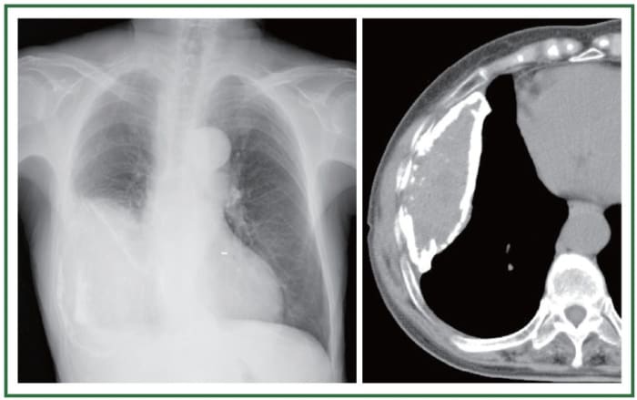 The inflamed pleural layers rub against each other every time the lungs expand to breathe in air. This can cause sharp pain when breathing, also called pleuritic chest pain.