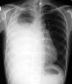 The lung fluid is examined under a microscope and is evaluated for the presence of chemicals and for its color and texture. The degree of clarity is an indicator of infection, cancer, or other conditions that may be causing the buildup of fluid or bl