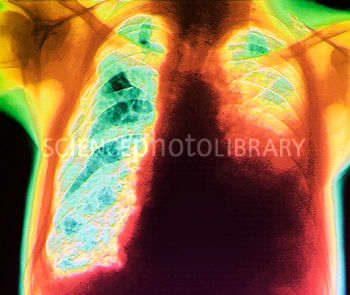 Pleurisy In Chest X-Ray: Various Radiographs To Show And Depict This ...