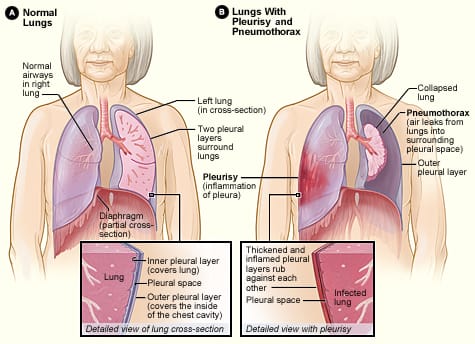 Once the presence of an excess fluid in the pleural cavity, or pleural effusion, is suspected and location of fluid is confirmed, a sample of fluid can be removed for testing