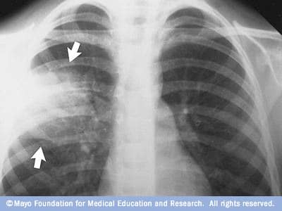 Thoracentesis can be done in the doctor's office or at the hospital. Ultrasound is used to guide the needle to the fluid that is trapped in small pockets around the lungs.
