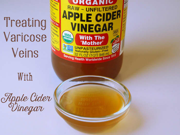 Get Rid Of Varicose Veins With Apple Cider Vinegar Treatment Hubpages