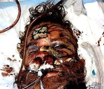 This is how Mr. Thomas looked after his beating as he lay dying in the hospital.
