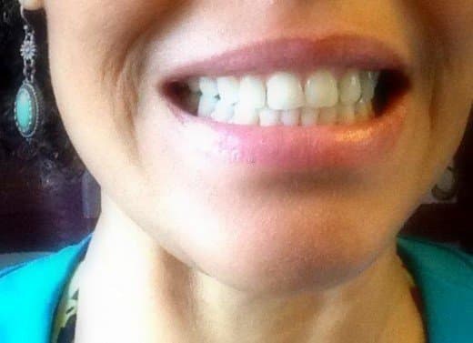 Although, lupus did damage my teeth a great deal, I managed to stop it in its tracks with my herbal remedies, as well as frequent visits to the dentist. I have not had an oral ulcer in several years, and bleeding gums have been reduced drastically.