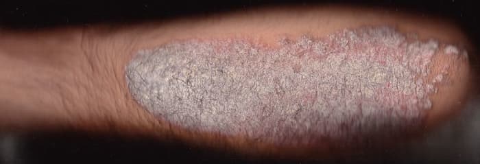 Psoriasis on the arm