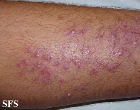 Bacterial folliculitis