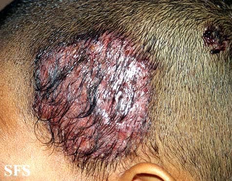 Scalp ringworm - Tinea capitis