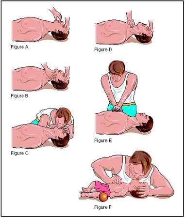 Illustrates the proper hand position and technique for the head tilt-chin lift, breathing, and chest compressions.