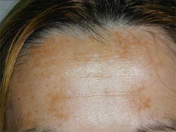 Tips to Remove Dark Spots and Hyperpigmentation From Face - HubPages