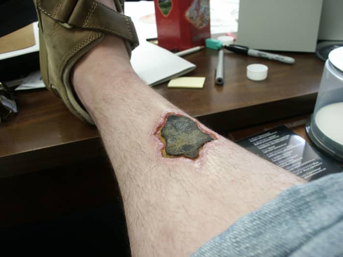 A severe brown recluse spider bite after two months. The flesh in the area of the bite has necrotized and was removed a month later.