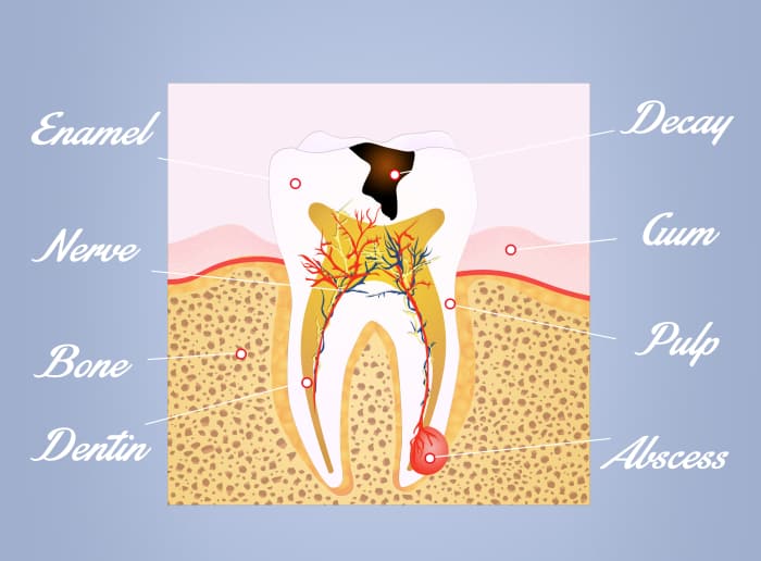 How to Get Rid of an Abscess Tooth Pus and Pain at Home? HubPages