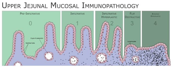 Flattening of intestinal villi in a person with untreated celiac disease