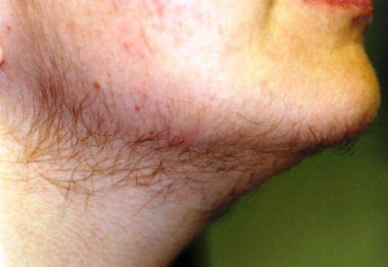 Hair on the chin and upper lip is seen in hirsutism resulting from any cause. It is the most visible (and most distressing) type of hirsutism