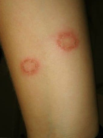 Tinea Corporis - Pictures, Treatment, Causes, Symptoms - HubPages