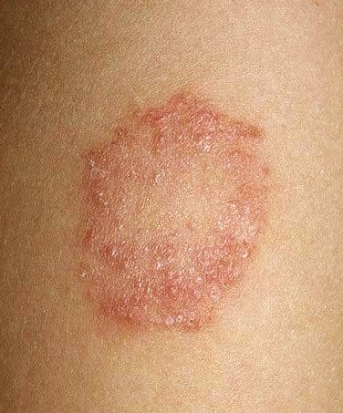 Tinea Corporis - Pictures, Treatment, Causes, Symptoms - HubPages