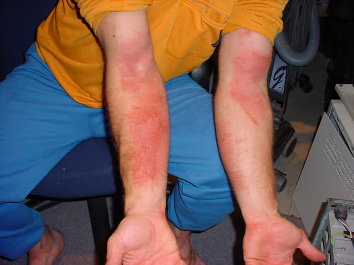 Rash after giving a dog a rub down, Obviously the dog had been in a poisonous plant area.