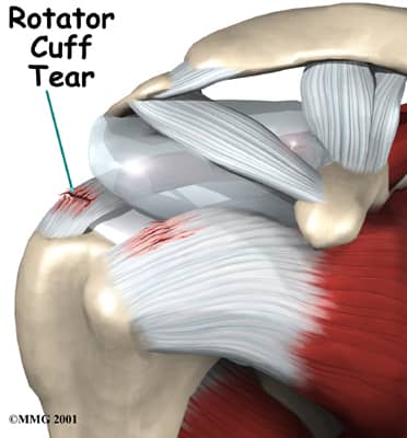 Rotator cuff tears are the most common forms of disorders in medical science relating to upper extremities