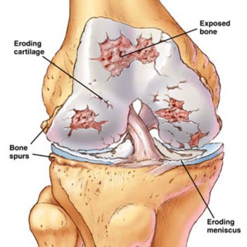 A knee with arthritis in all three compartments. this is a right knee viewed from in front. The kneecap is not shown to enable a better view