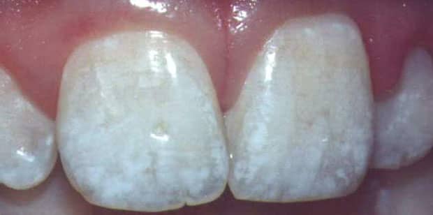 Dental fluorosis is a reflection of what's happening in our bones and is the first visible sign of fluoride poisoning Picture courtesy of http://www.fluoridation.com/teeth.htm