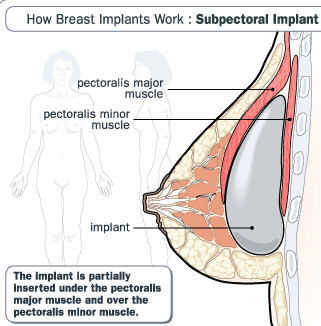 brest-implants-make-bigger-boobs