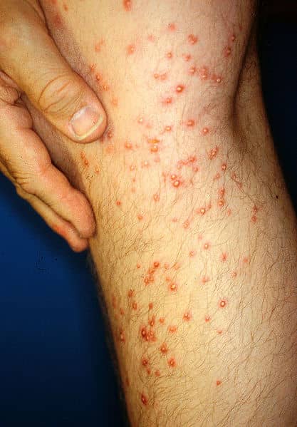A Human Leg Three Days After Contact And Attack By Fire Ants. Fire Ants Will Attack So Approach Them With Caution.