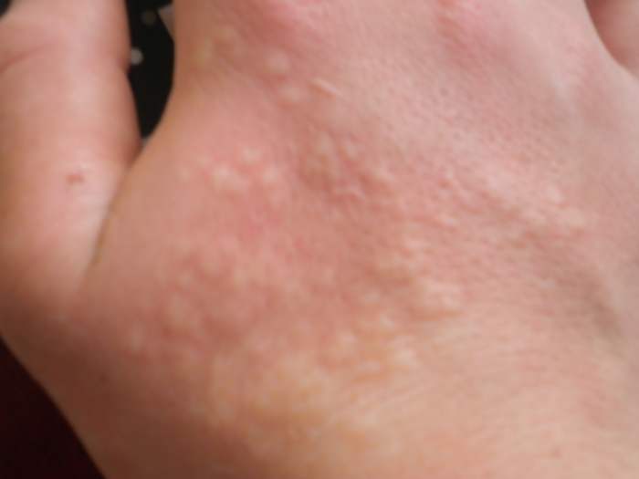 Nettle Plant Tonic Recipe HubPages