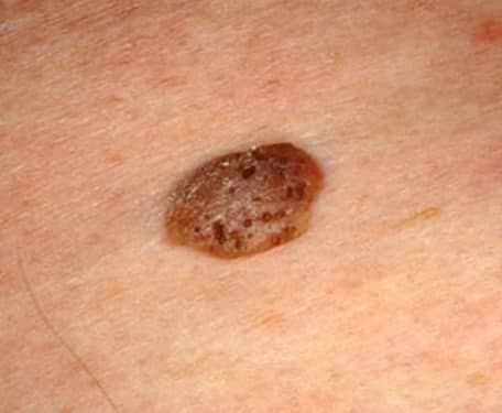 Seborrheic Keratosis - Pictures, Symptoms, Treatment, Removal And 