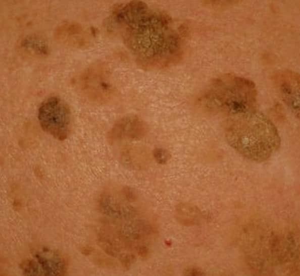 Seborrheic Keratosis - Pictures, Symptoms, Treatment, Removal and ...