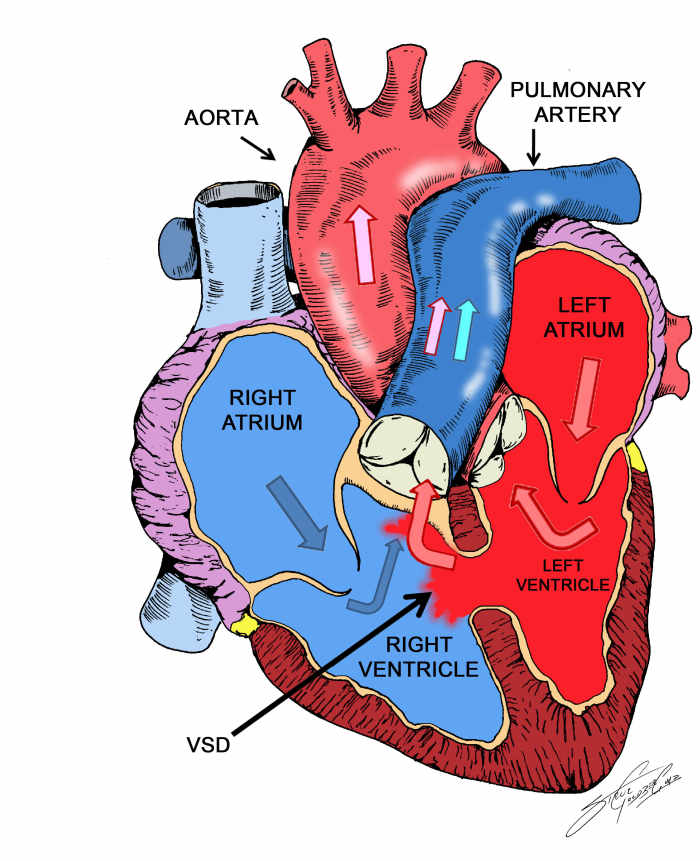 Large VSDs can result in congestive cardiac failure in infancy. Recurrent respiratory infection and failure to thrive may also be noticed. Those who survive develop varying degrees of pulmonary hypertension.