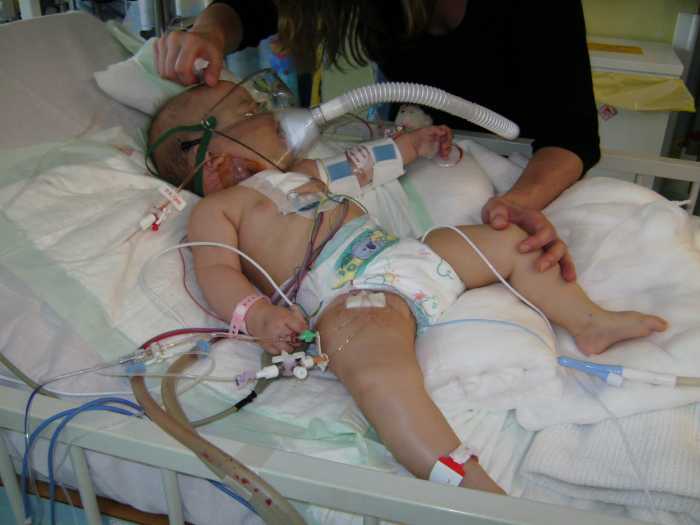 Complications may occur. These include congestive cardiac failure, Eisenmenger syndrome, infective endocarditis and aortic incompetence due to prolapsed of the aortic valve cusp through the defect.