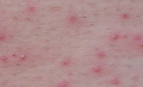 Folliculitis – Pictures, Symptoms, Causes, Treatment - HubPages