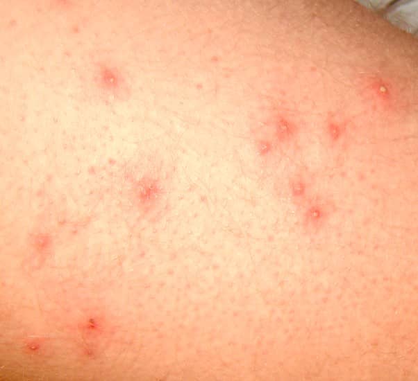 Folliculitis Pictures Symptoms Causes Treatment Hubpages 