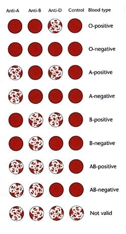 This chart demonstrates the standard ABO blood typing test results and each result's associated ABO and Rh D blood type.