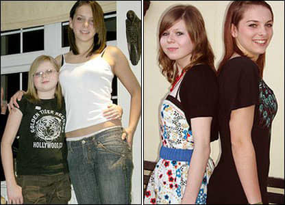 These twins on the left at age 12. You can see the smaller girl looks much younger than her twin as well as being significantly shorter. After treatment the girls appear much closer to the same age, and are closer to height.