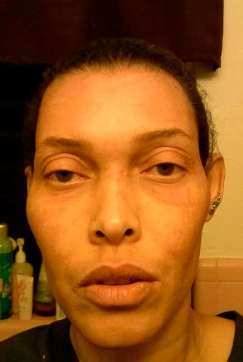 Some days I would wake up to a swollen face, with a rash that covered almost all my face, but most of the time it was across my face.