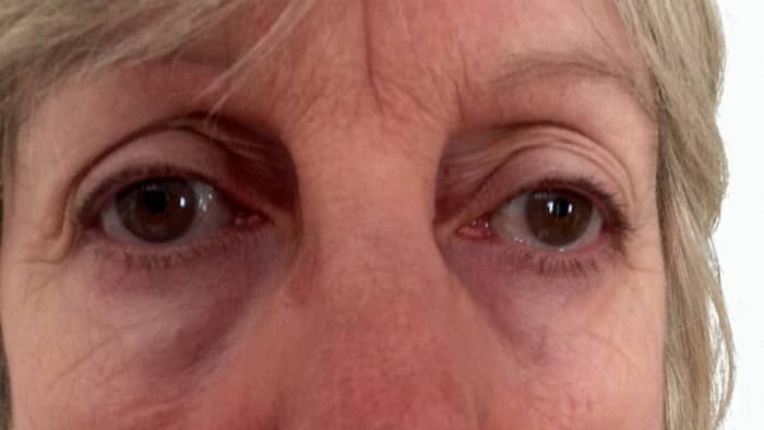 If you are looking at a reflection in the mirror, that looks older than you feel inside, maybe it is time to do something about those dark, under eye circles!
