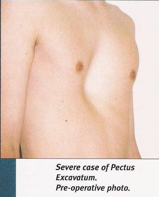 the caption below says severe but to be honest this level of P.E would be considered moderate at most but I'm sure proper medical exams may indicate differently, for example pressure on organs