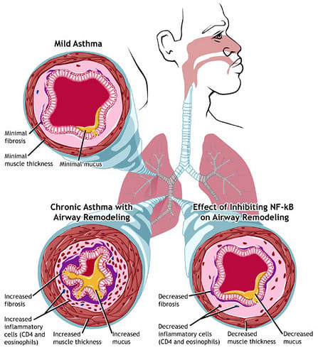 Asthma sufferers have trouble breathing because of the narrowing of the airways in their lungs, an example of which is shown in the upper left. In chronic asthma (lower left), repeated cycles of inflammation, damage, and repair lead to airway remodel