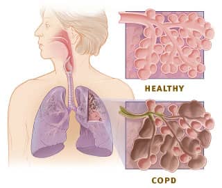 Healthy lung vs COPD lung