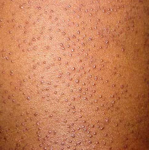 keratosis pilaris causes