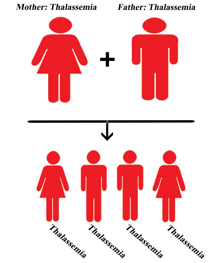 When both the mother and father have thalassemia; Chances of children with thalassemia: 100%, Chances of children who are carriers: 0%