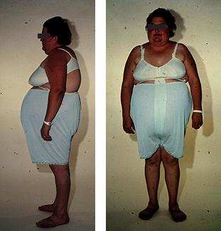 ...and create this type of obesity...because they change metabolism, kill immune system and destroy inner organs...after long-term use...it is called "ugly disease"