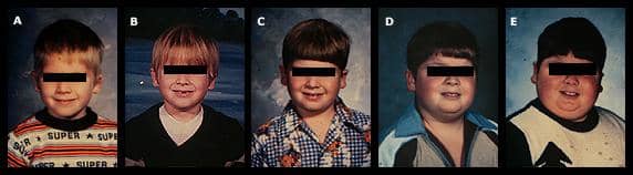 Sequence of pictures in a boy with Cushing's disease. A: Age 6, before Cushing's Panel B: Age 7, still with little evidence Panel C: age 8, with early facial roundness