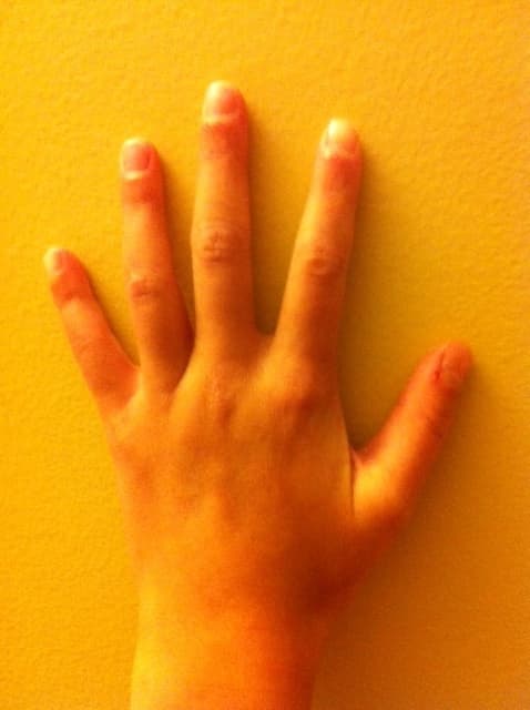 Mixed hand shape:round thumb, pointed index and forefinger, square ring finger, spatula pinky. Rare indeed.