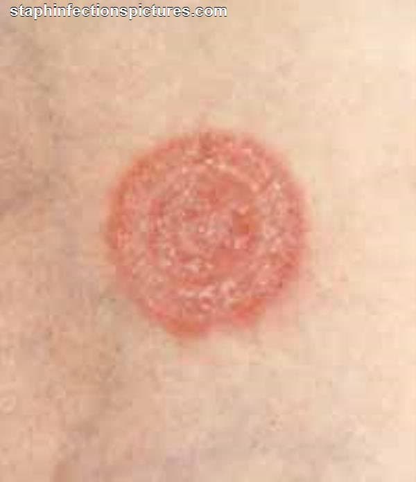 How Do You Get Ringworm - Can You Get Ringworm If Unclean - HubPages