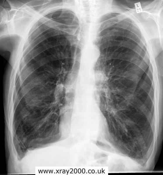 Emphysema and COPD From Smoking My Experience With Lung Disease HubPages