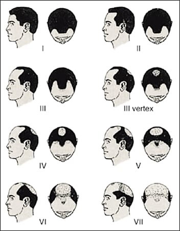 Norwood-Hamilton Scale of Male Pattern Baldness, published in Expert Reviews of Molecular Medicine by Cambridge University Press 2002- 2013 Hairstyles for Men with Balding Thinning Hair Style Cuts Trends by Rosie2010