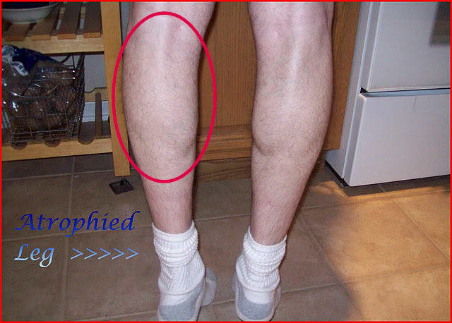 Are You Suffering From Muscle Atrophy? - HubPages