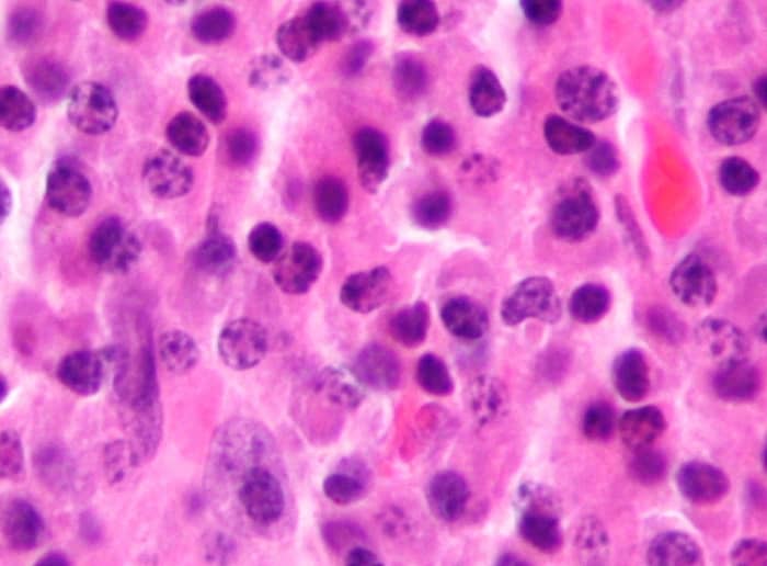 The micrograph shows abundant malignant plasma cells. Multiple Myeloma